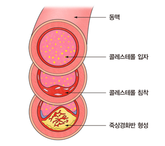 LDL-Cholesterol